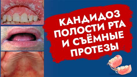 Причины продолжительной сохранности липкости органа полости зева и вероятные пути решения проблемы